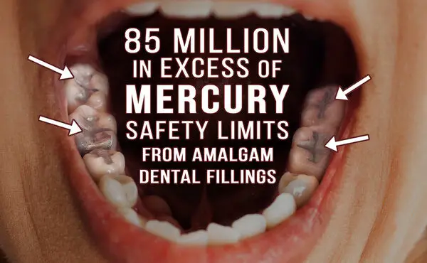 amalgam Cavity Fillings Contain Over 50% Toxic Mercury