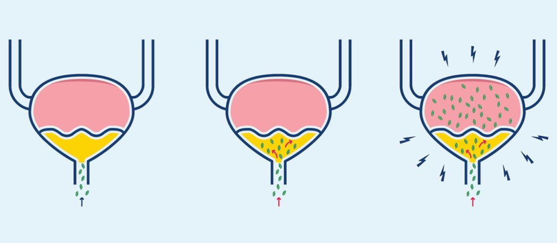 urinary tract infection