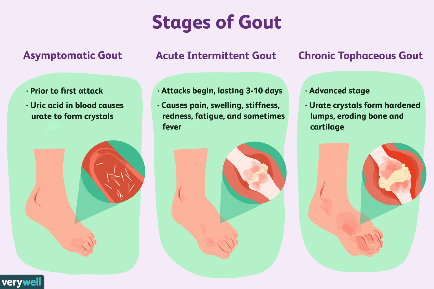 gout