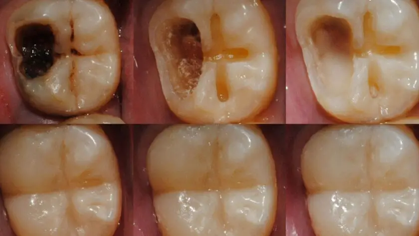 tooth regeneration